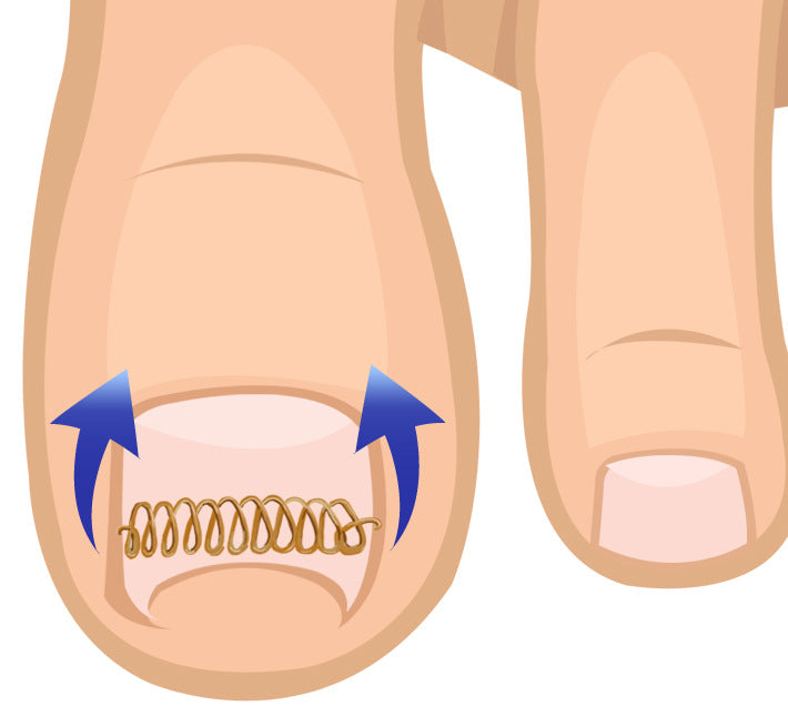 Orthodontic Wire Pad Corrector Correction Wire