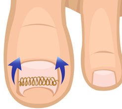 Orthodontic Wire Pad Corrector Correction Wire