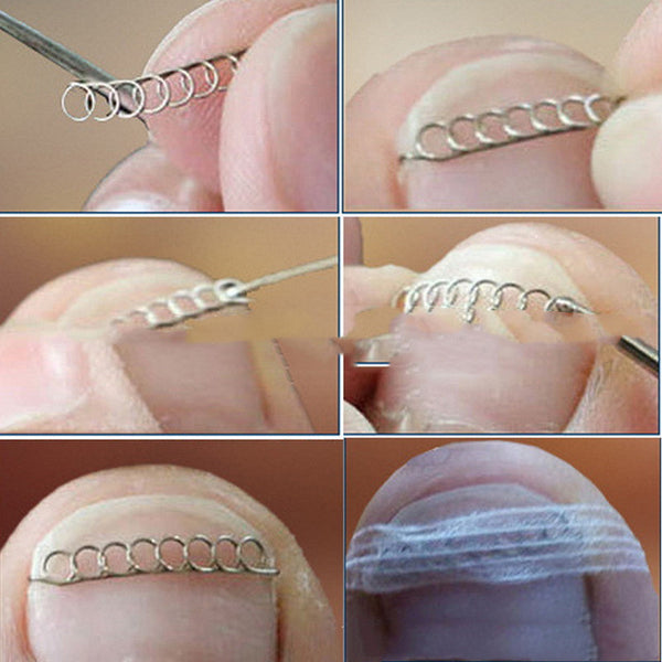Orthodontic Wire Pad Corrector Correction Wire